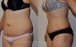 abdominoplastia-2