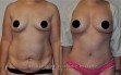 abdominoplastia-3